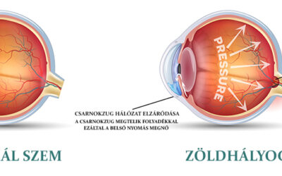 Mi a zöldhályog, vagy szakmai nevén Glaucoma?