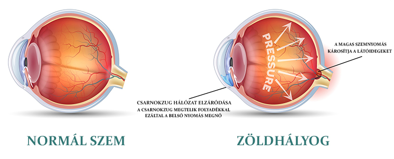 Mi a zöldhályog, vagy szakmai nevén Glaucoma?
